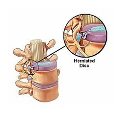 2 Lumbar Vertebrae With Hernia And Prolapsed Intervertebral Disc