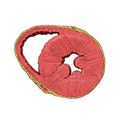 Heart Hypertrophy Model